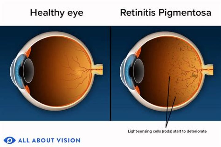 Does retinitis pigmentosa affect a certain race?