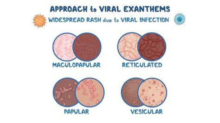 Does viral exanthem itch?
