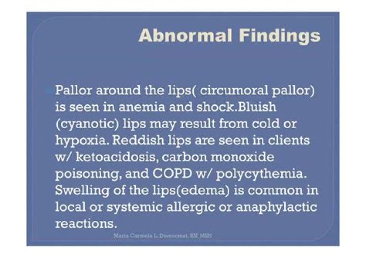 Is circumoral pallor normal?