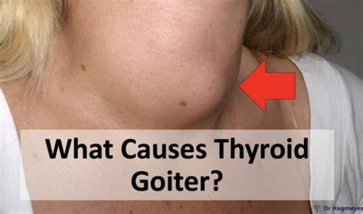 Is goitre an infectious disease?