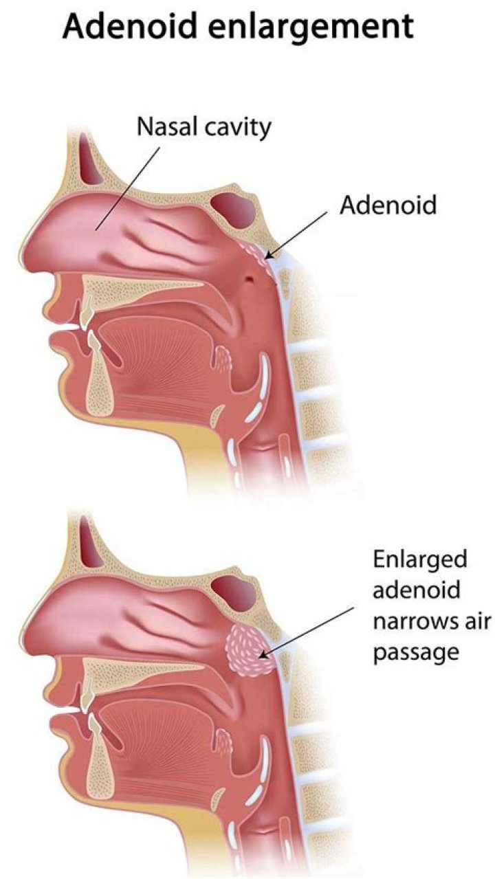 What are adenoids and why remove them?