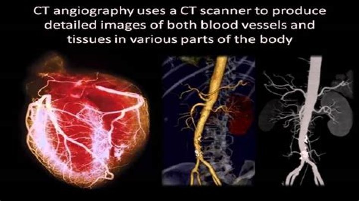 What is a computed tomographic angiography?