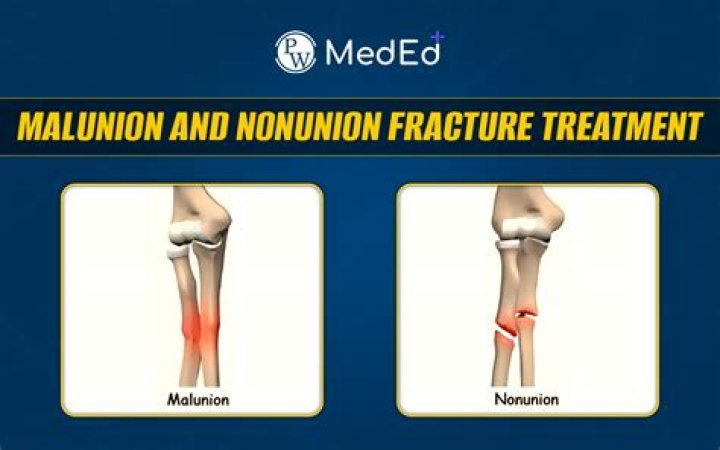 When is a fracture considered nonunion?