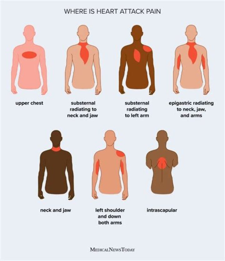 Which arm is painful before a heart attack?