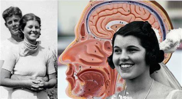 Which kennedy had a lobotomy?