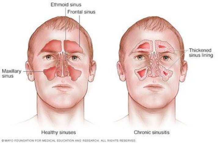 Why are my sinuses so dry?