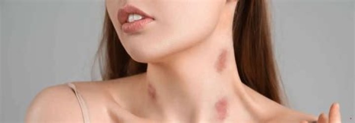 Why hickeys are dangerous?