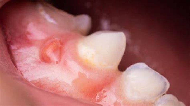 Why is my gum bubbled up?