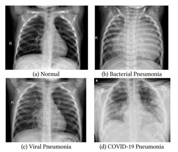 Will a chest xray show covid?